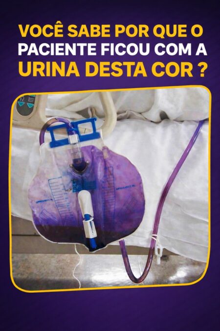 Urina roxa na bolsa coletora chama atenção e pode indicar infecção urinária associada a sonda