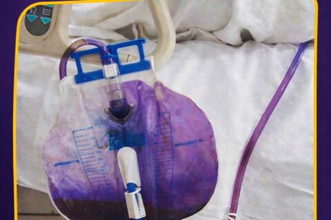 Urina roxa na bolsa coletora chama atenção e pode indicar infecção urinária associada a sonda