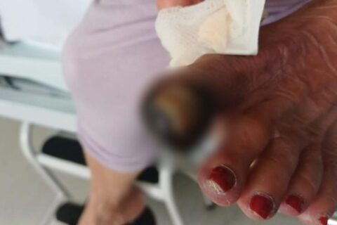 Idosa de 74 anos pode ter o pé amputado à espera de cirurgia