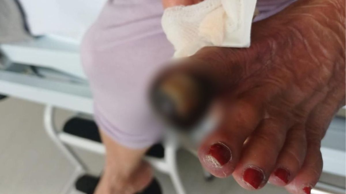 Idosa de 74 anos pode ter o pé amputado à espera de cirurgia